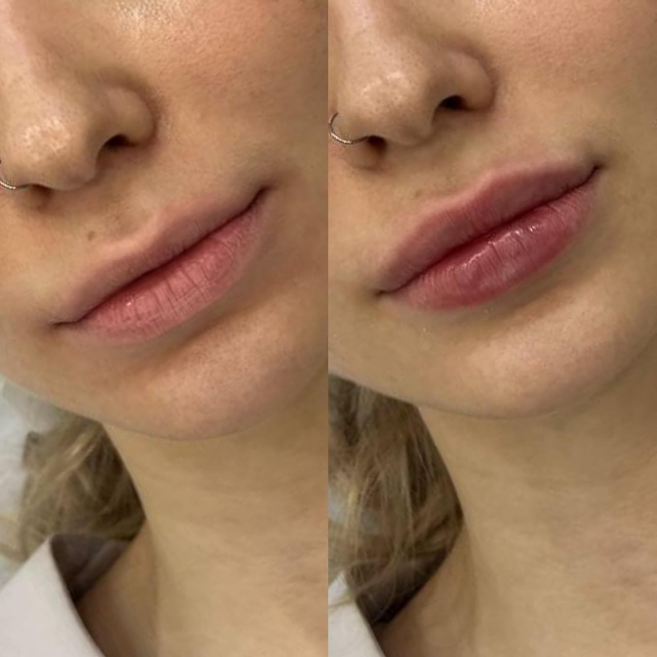 увеличение губ